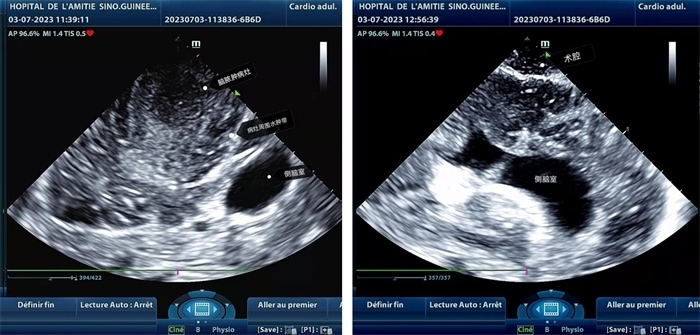 左圖顯示術(shù)中超聲見(jiàn)囊實(shí)性病變，大小約為4x4x3cm，病灶周圍腦組織水腫明顯；右圖為病灶切除后，術(shù)中超聲示術(shù)腔無(wú)病變殘留