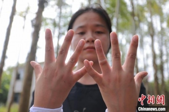 吳素英展示被蜜蜂蜇過(guò)的雙手。湯曉逵 攝