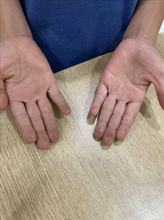 9歲小學生長期拍煙卡，手部粗糙長繭。受訪者供圖