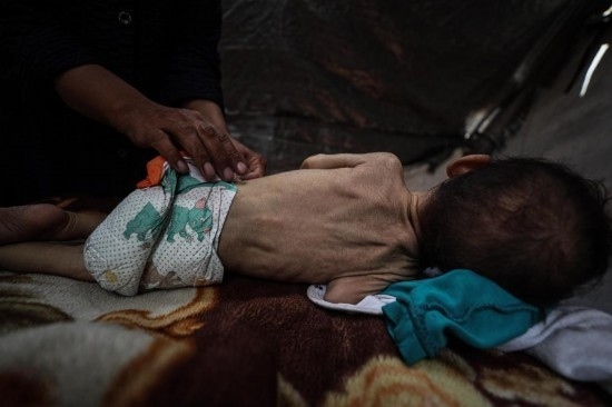 這是5月28日在加沙城西部一處臨時(shí)安置點(diǎn)拍攝的一名營(yíng)養(yǎng)不良的嬰兒。新華社發(fā)（馬哈茂德·扎基攝）